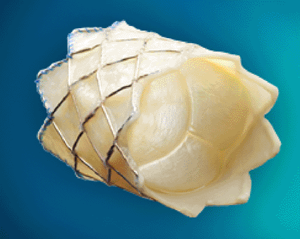 Image: The Melody Transcatheter Pulmonary Valve Therapy (Photo courtesy Medtronic). Image: The Melody Transcatheter Pulmonary Valve Therapy (Photo courtesy Medtronic).